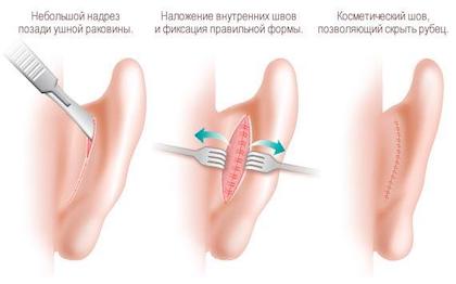 Отопластика 